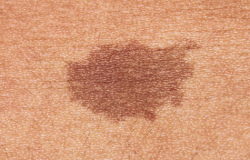 Melanoma_Symptoms_Large_Mole